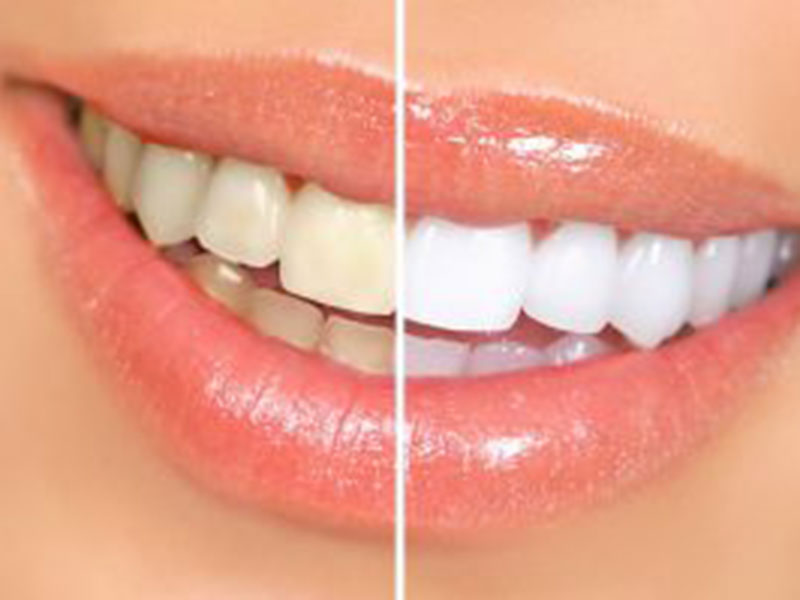 Featured image for “Methods of Teeth Whitening”